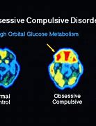 Image result for Brain Scans of People with OCD