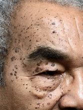 Image result for Dermatosis Papulosa Nigra