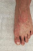Image result for Lupus Skin Rash On Feet