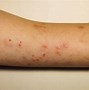 Image result for Skin Eruptions in Covid
