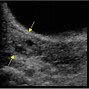 Image result for Ovarian Cyst Rupture Ultrasound