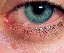 Image result for Molluscum Contagiosum Eyelid