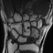 Image result for Scaphoid Fracture Avascular Necrosis