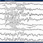 Image result for 6HZ Spike and Wave