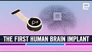 Elon Musk’s Neuralink brain implant: New era of "Brain-Computer Interface" (BCI) technology