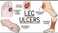 Understanding Leg and Foot Ulcers