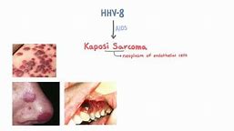 HHV-8 and Kaposi Sarcoma