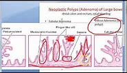 Pathology 521 g Neoplastic polyp tubular adenomatous villous papilloma tubulovillous papillary