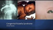 Congenital Rubella Syndrome: Early and Late Onset Manifestations