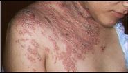 Herpes zoster Pictures HD - Signs, Symptoms, Images, Photos and Pictures of Herpes zoster Shingles