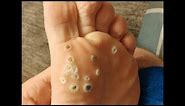 Plantar Wart Removal! How to Remove Plantar Warts!