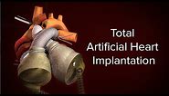 Medical Animation: Total Artificial Heart Implantation | Cincinnati Children's