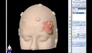 Removal of Brain Tumor: Meningioma (brain surgery)