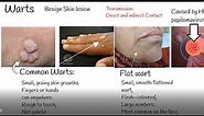 Warts causes and treatment, Wart Types,