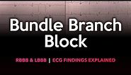 Left and Right Bundle Branch Block: ECG Made Easy