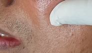 Removing Face Warts Safely and Effectively: Treatment Options at DTC Skin Clinic
