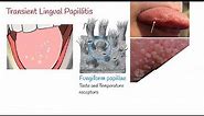 Transient lingual papillitis (Lie Bumps) - Inflammation of the tongue