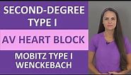 Second-Degree Type I AV Heart Block Nursing NCLEX ECG | Mobitz Type 1 | Wenckebach