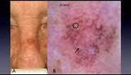 The inverse approach for lentigo maligna diagnosis - Dr Aimilios LALLAS