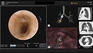 Robotic-Assisted Bronchoscopy to Evaluate a Solitary Peripheral Lung Nodule