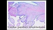 Cardiac papillary fibroelastoma