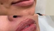 Juvederm Ultra Plus XC: The Best Natural Looking Lip Filler by Christina RN #004