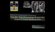 Ultrasound Case 224 - Torsion of Fetal Ovarian Haemorrhagic Cyst