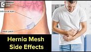 Can Hernia mesh cause problems years later? Signs, Symptoms, Treatment - Dr. Nanda Rajaneesh