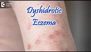 Dyshidrotic Eczema ( POMPHOLYX ) : Causes, Symptoms, & Treatment - Dr. Nischal K | Doctors' Circle