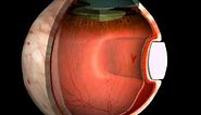 Retinal-Detachment - evrs
