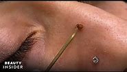 Fibroblast Pen Instantly Removes Moles | Beauty Insider