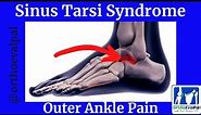Sinus Tarsi Syndrome (Outer Ankle Pain)