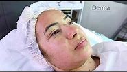 GREEN PEEL TREATMENT - BEST FOR PIGMENTATION AND SCARS | Dermacure Clinic