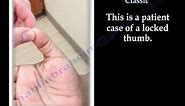 locked Trigger Thumb Classic - Everything You Need To Know - Dr. Nabil Ebraheim