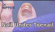 Old Nail on Top of New Toenail (2022)