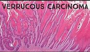 Verrucous carcinoma (it's NOT caused by HPV) pathology dermpath dermatology dermatopathology
