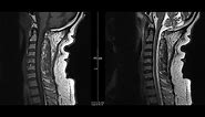 Noncontrast MRI cervical spine search pattern