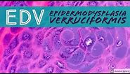 Epidermodysplasia verruciformis (EDV) 101