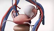 Laparoscopic Ovarian Cystectomy - TVASurg - The Toronto Video Atlas of Surgery