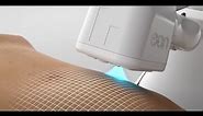 Laser liposuction technology - EON robotic body contouring - 3D animation