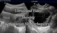 Ovarian Hemorrhagic Cyst Ultrasound