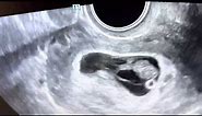 Take a Peek! Ultrasound of a triple sac pregnancy at 8 weeks, continuing as twins!