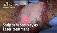 Scalp sebaceous cysts - Laser treatment - 23175