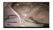 18cm Size Broad Ligament Fibroid Arising from Isthamus • Video • MEDtube.net