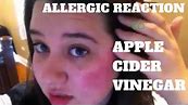 Allergic Reaction To Apple Cider Vinegar | Enough To Make Your Hell