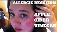 Allergic Reaction To Apple Cider Vinegar | Enough To Make Your Hell