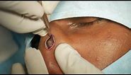 Easy Painless Scar Removal on Nose | Dr. Sunil Richardson