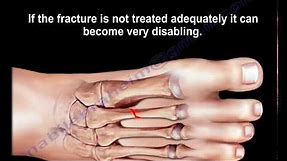 Stress Fractures Of The Metatarsal Bones - Everything You Need To Know - Dr. Nabil Ebraheim