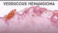 Verrucous Hemangioma (pathology dermpath dermatology dermatopathology)