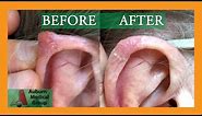 Before and AFTER Basal Cell Carcinoma Biopsy on the EAR | Auburn Medical Group